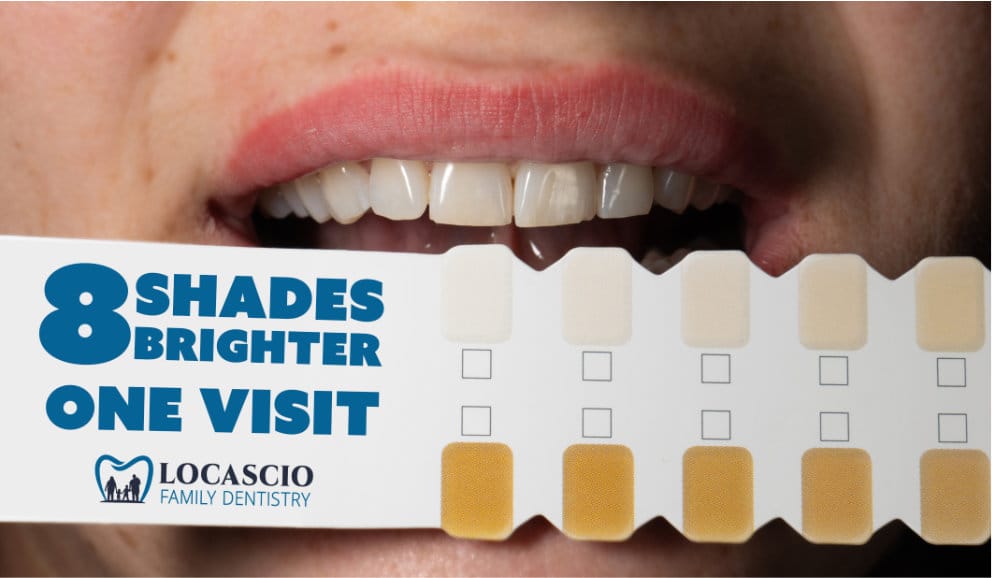 Tooth color shade chart. Up to 8 shades whiter in one visit.
