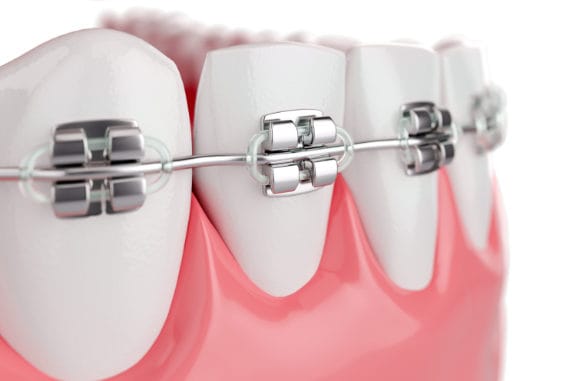 3d render of several lower teeth with braces on