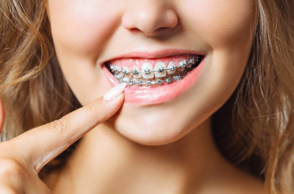 a close-up photo of a woman smiling showing her teeth with dental braces